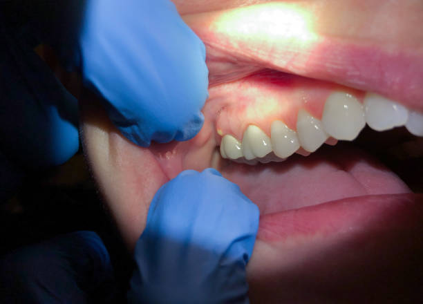 Best Urgent Care for Lost Fillings or Crowns in Apollo Beach, FL